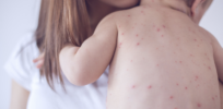 What constitutes a measles death? RFK, Jr. maneuvers to restrict definition to make pandemic seem less dire