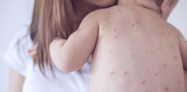 What constitutes a measles death? RFK, Jr. maneuvers to restrict definition to make pandemic seem less dire