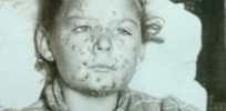 Victims of their own success: As memories of killer diseases fade, vaccine rejectionism soars