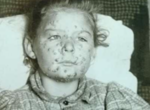 Victims of their own success: As memories of killer diseases fade, vaccine rejectionism soars
