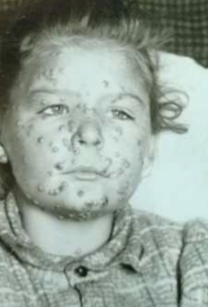 Victims of their own success: As memories of killer diseases fade, vaccine rejectionism soars