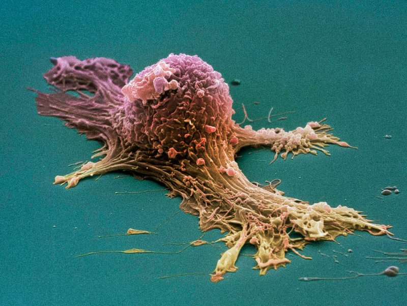 ovarian cancer cell sem steve gschmeissner