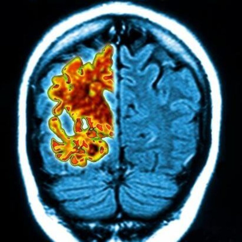 Alzheimer brain NEWS large transq ZJCiq lwABXAhqKAJFwZTvzHCMPv JvvnmcF MEY