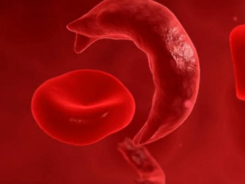 231208_gma_digital_sickle_cell_hpMain_4x3_608