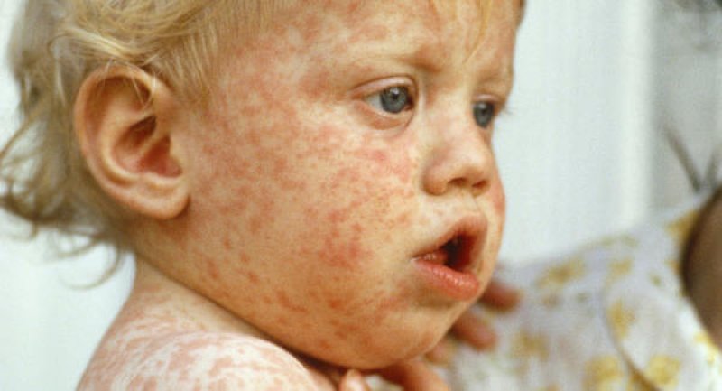 measles wide