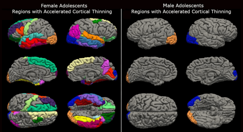 The thinning of the cortex is seen by scientists as the brain rewiring itself as it matures. Credit: Institute for Learning and Brain Sciences, University of Washington