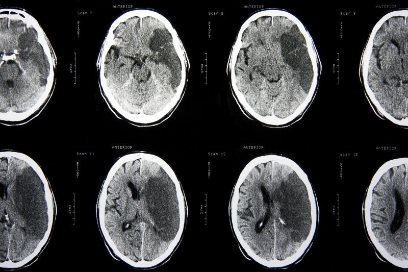 bigstock CT brain