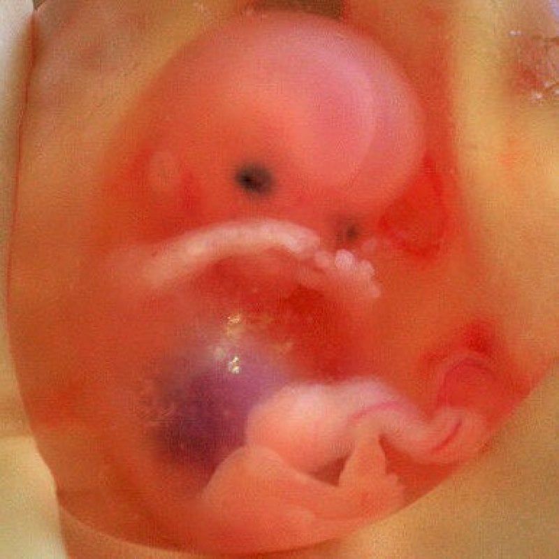 px Human fetus weeks with amniotic sac therapeutic abortion