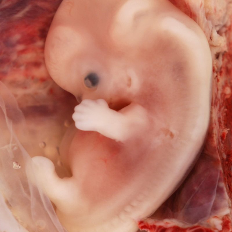 Week Human Embryo from Ectopic Pregnancy