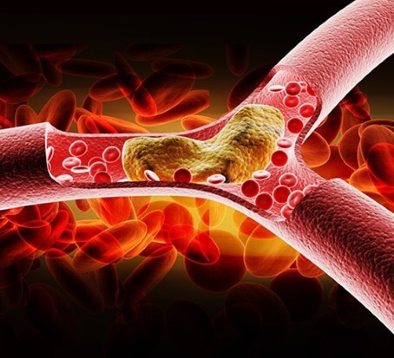Blood blockage