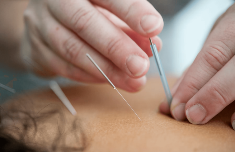 Viewpoint: Acupuncture pseudoscience — Washington Post’s tiresome promotion of ‘legalized quackery’