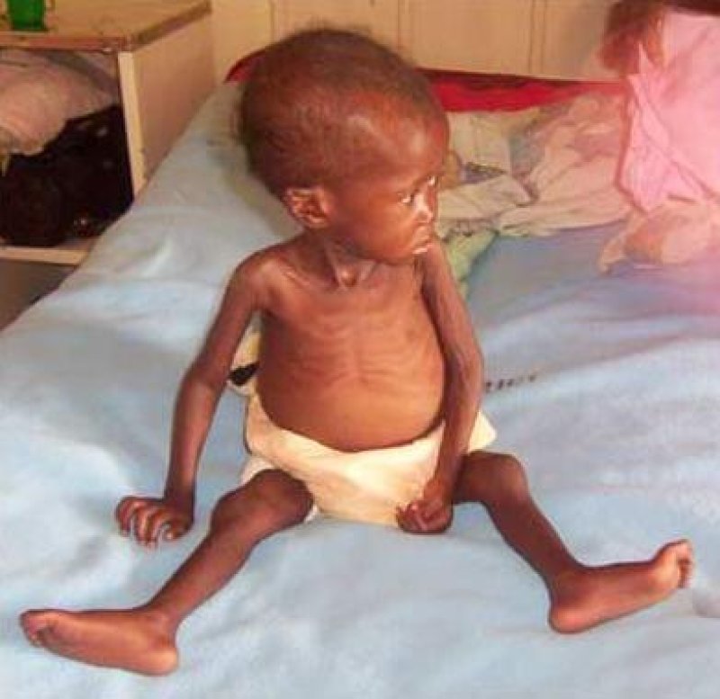 Malnourished_child