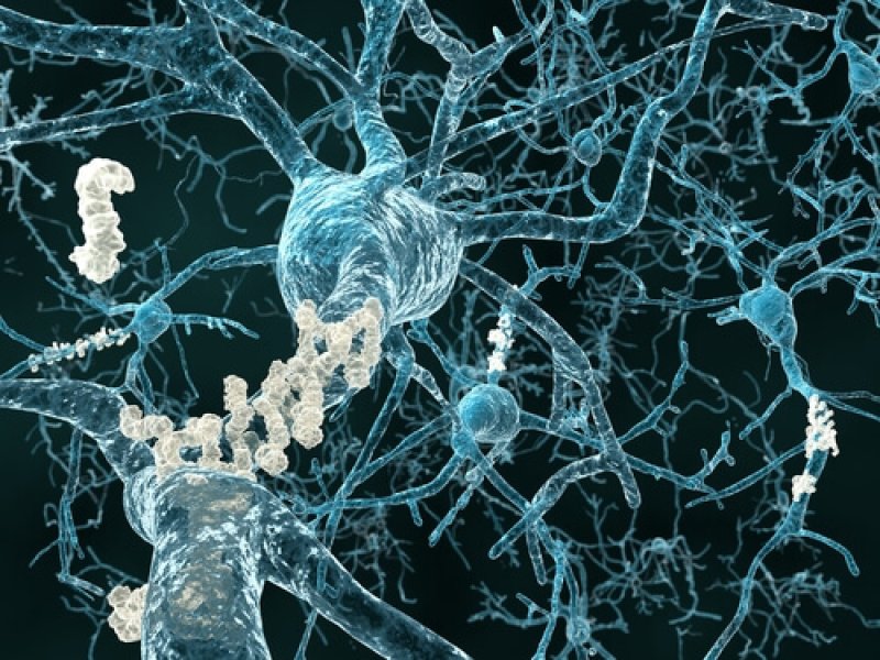 Neurons with amyloid plaques