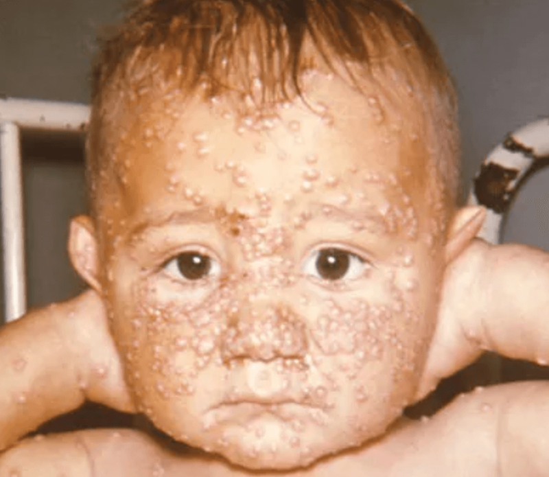 Credit: Centers for Disease and Prevention Public Health Image Library; by Dr. Noble, 1966