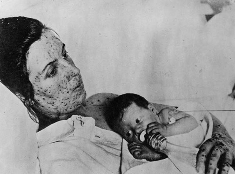 Small Pox mother with her children
