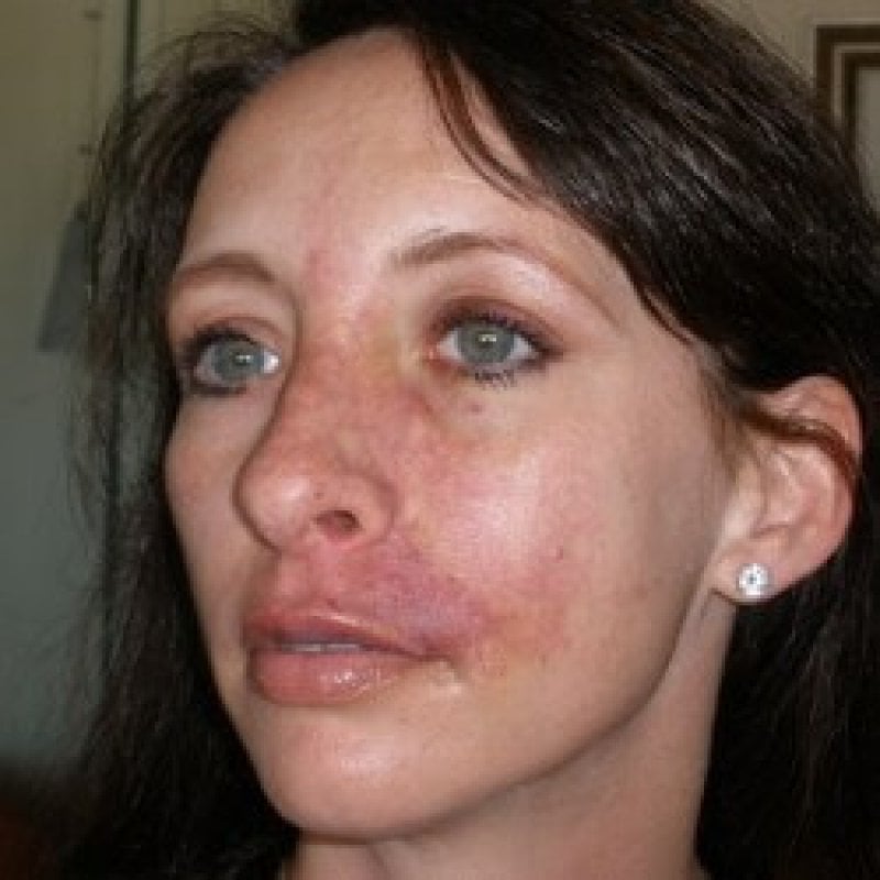 Staph Infection on face