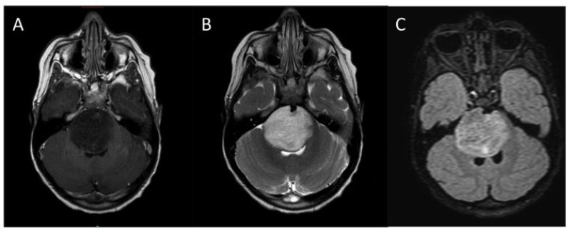 Typica l MRI appearance of DIPG A T weighted post contrast B T weighted C FLAIR