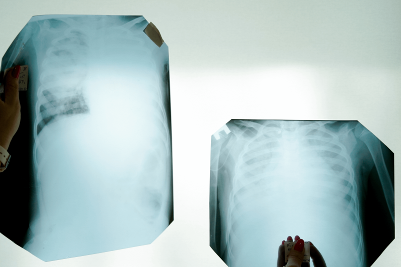 x ray photograph of lungs tissue involved by covid virus chernivtsi c ukraine