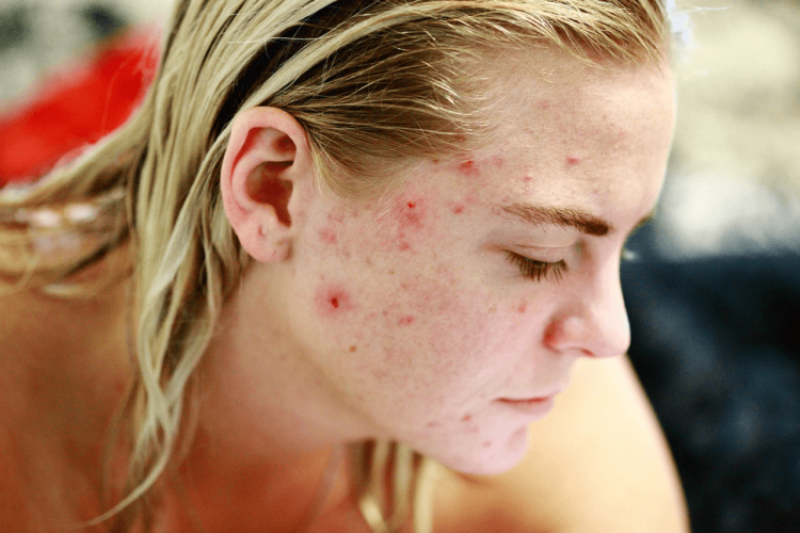 Acne treatment of the future: Gene-editing the bacteria that lives on your skin