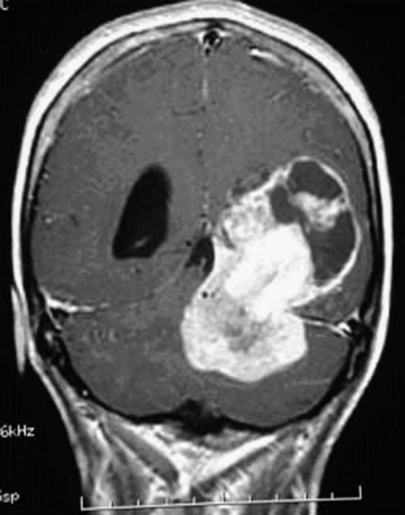 brain tumors fig large