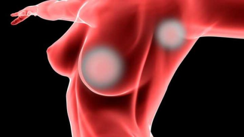 default researchers identify two new genetic variants linked to increased breast cancer risk
