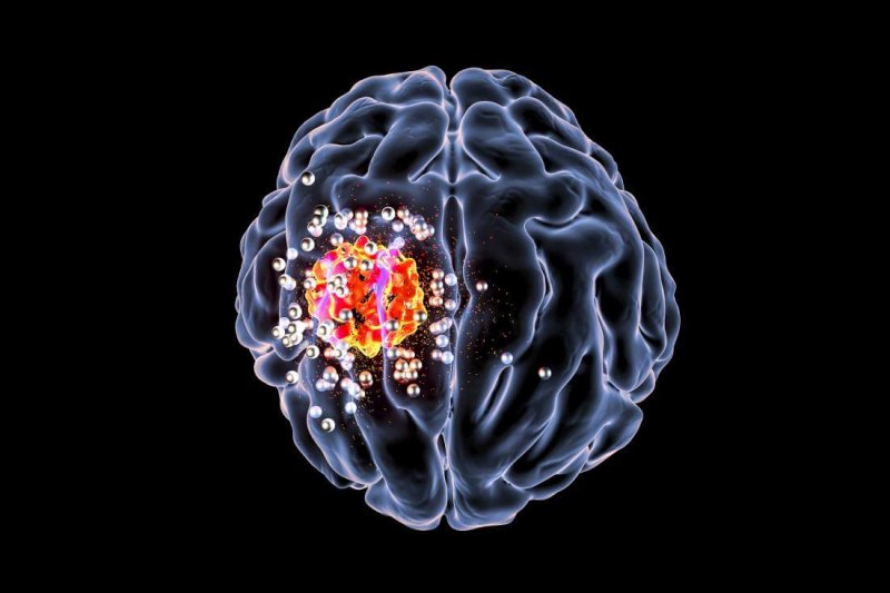 illustration of brain tumor