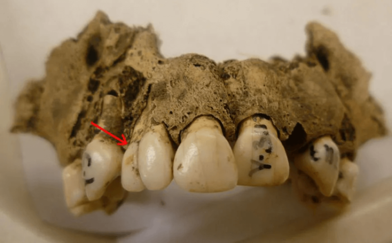 how dental plaque gives insight to our past
