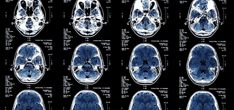 2-10-2019 metabolic brain age wpirhwy nb nr zl kg