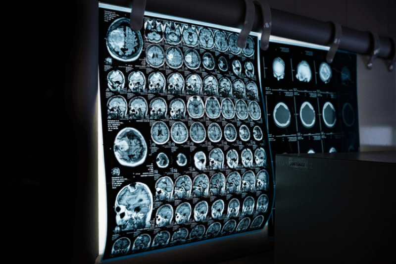 Male-female differences: MRI analysis of the brains of overweight women indicates they are more susceptible to future weight gain