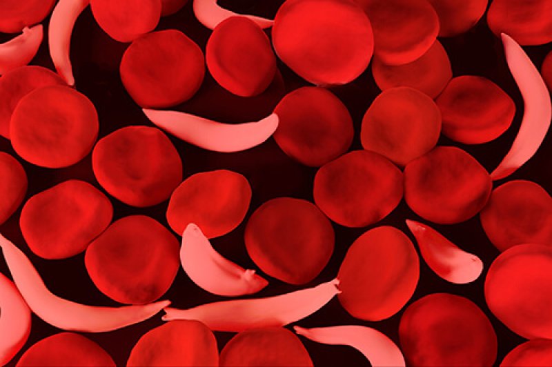 3d render of sickle cell anemia blood cells. Credit: Meletios Verras/iStock
