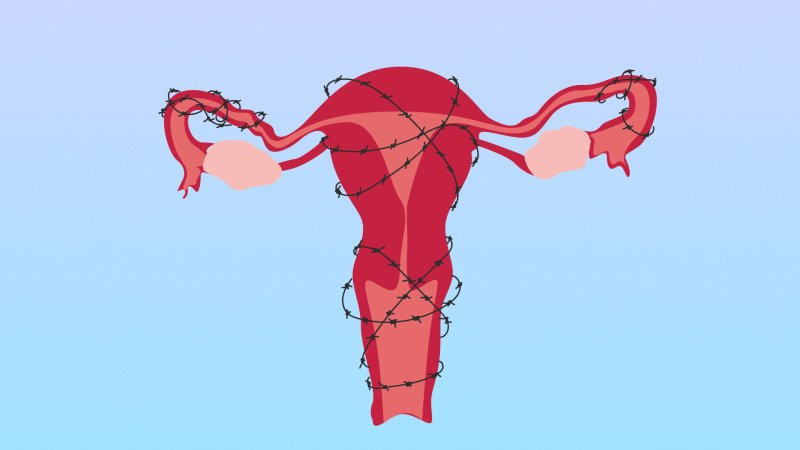 stages of endometriosis