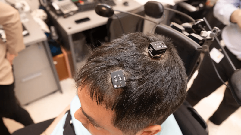 Thomas had five tiny microchips implanted in his brain, forming a critical portion of a first-of-its-kind "double neural bypass." The technology uses artificial intelligence to decode and translate his thoughts into action. Credit: Northwell Health’s The Feinstein Institutes for Medical Research/Fox News