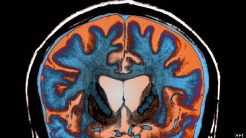 An MRI scan shows signs of atrophy in the brain of a patient with Huntington's disease. Credit: Science Photo Library/Science Source